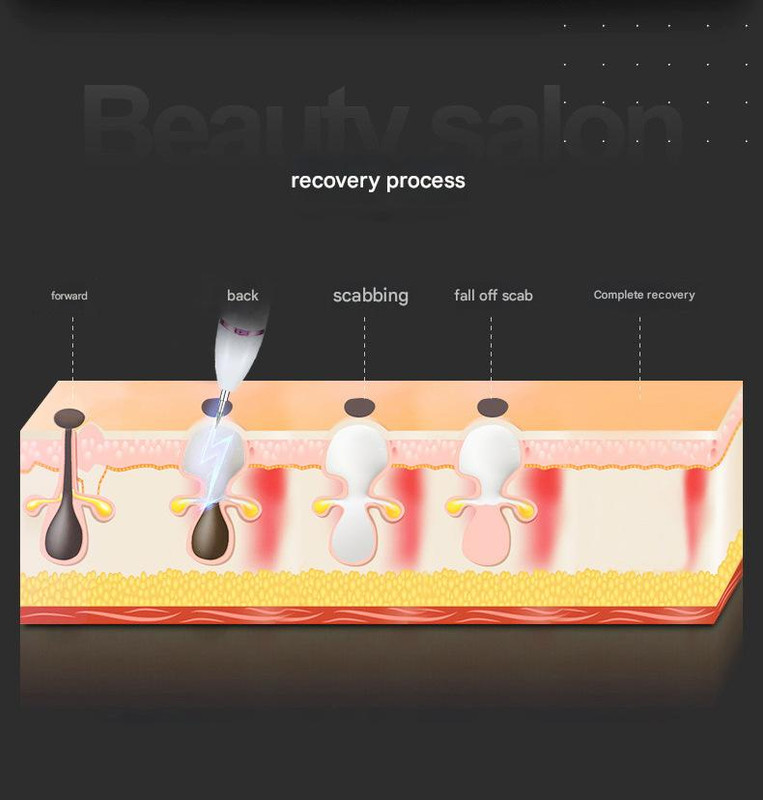 Professional Electric Mole & Dark Spot Remover Pen - Advanced Plasma Ion view 6