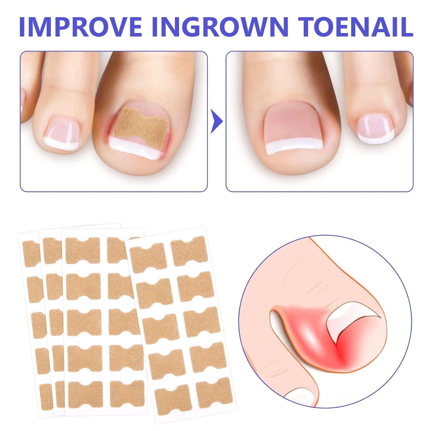 Toenail Treatment, 100Pcs Breathable Corrector Patch, Painless Nail Corrector view 5